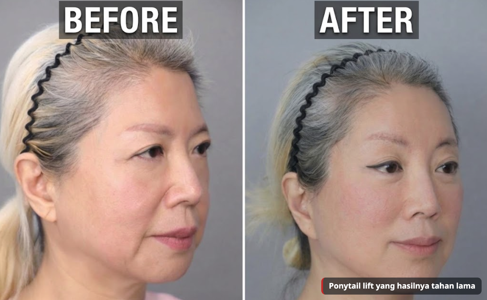 Sebelum dan sesudah ponytail lift dengan pelepasan periosteum tiga lapis